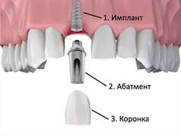 implantaciya_zubov1